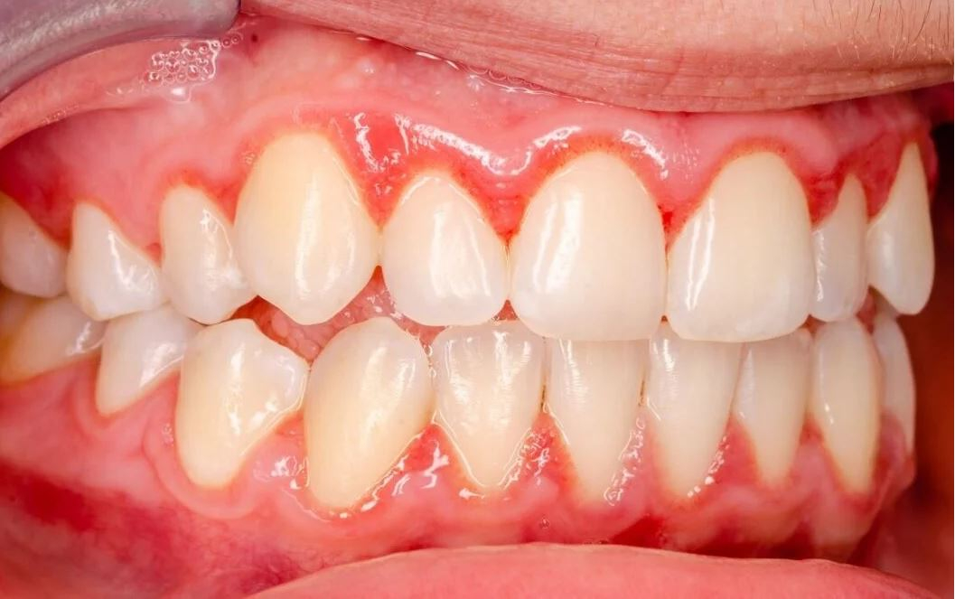 Gingivitis in vnetje dlesni